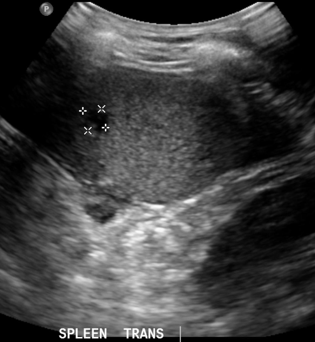 Hepatosplenic abscesses - chronic granulomatous disease | Image ...