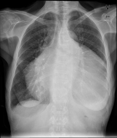 Pericardial effusion | Radiology Case | Radiopaedia.org