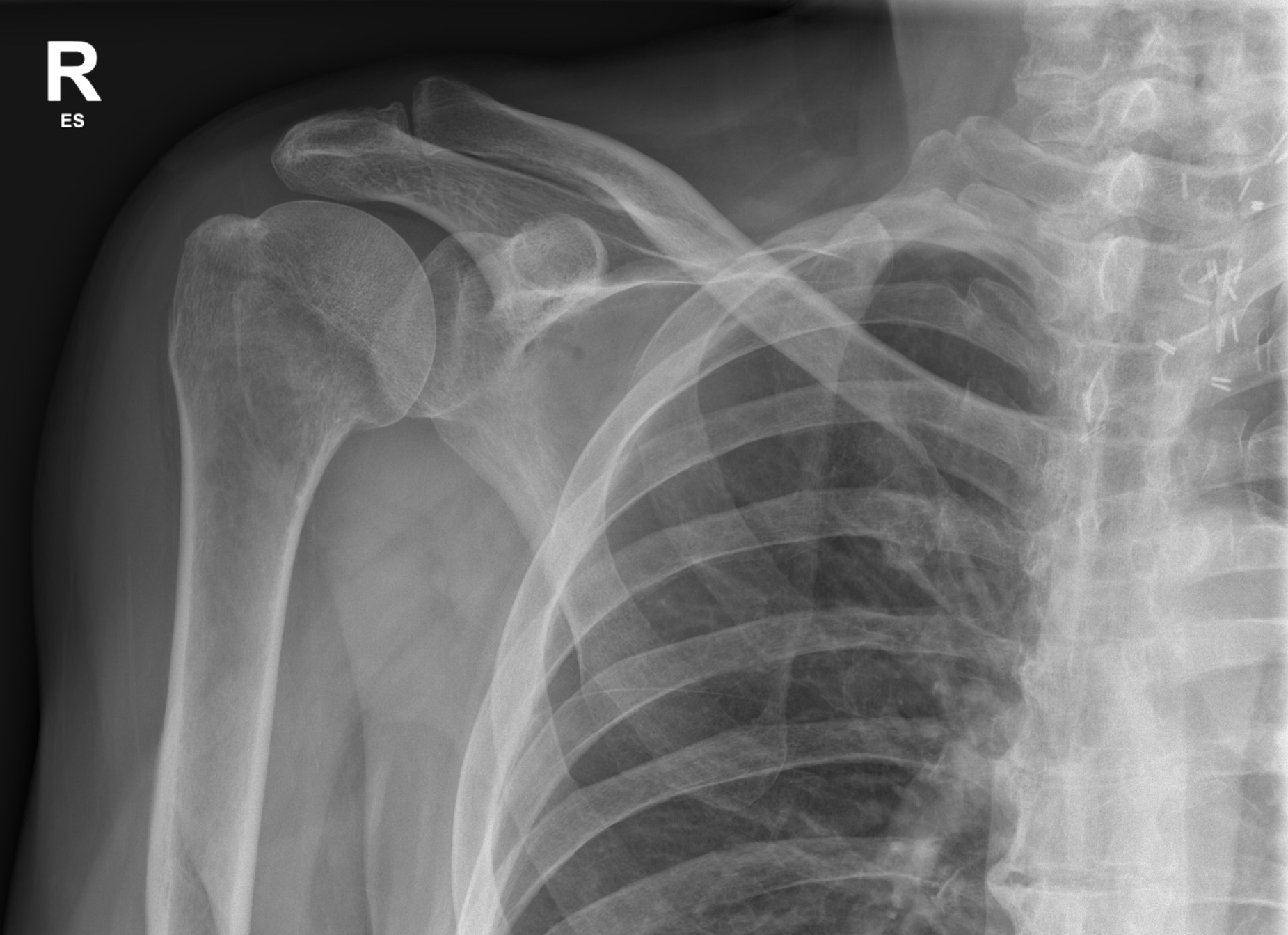 Anatomical neck of humerus fracture | Image | Radiopaedia.org