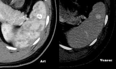 A Ct Scan Showing Cm In Size Splenic Hemangioma B Transverse | Sexiz Pix