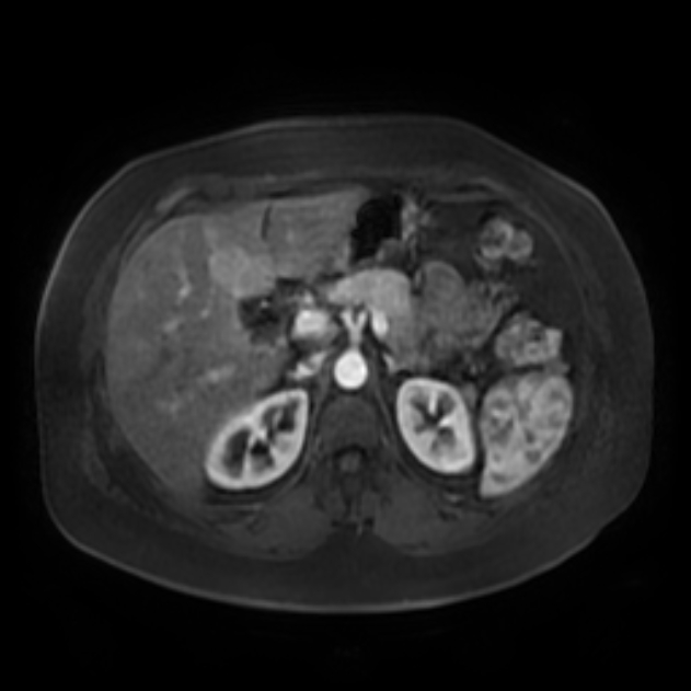 Acute calcular cholecystitis and Mirizzi syndrome | Image | Radiopaedia.org