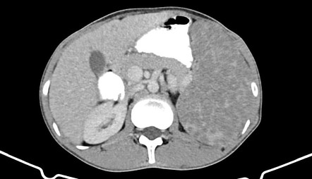 Splenic granulomatous disease | Radiology Reference Article ...