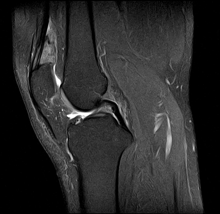 MRI Fat Pad Impingement Knee