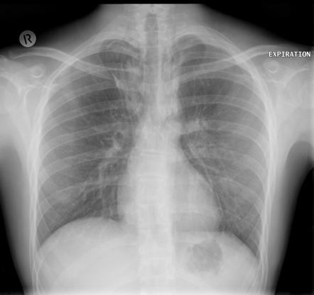 Azygos lobe | Radiology Reference Article | Radiopaedia.org