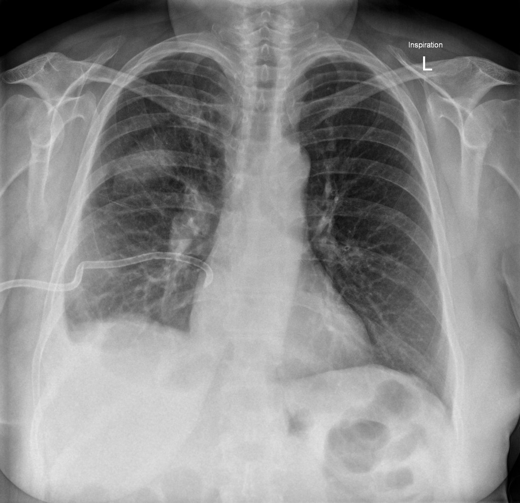 Pleural Effusion On CT