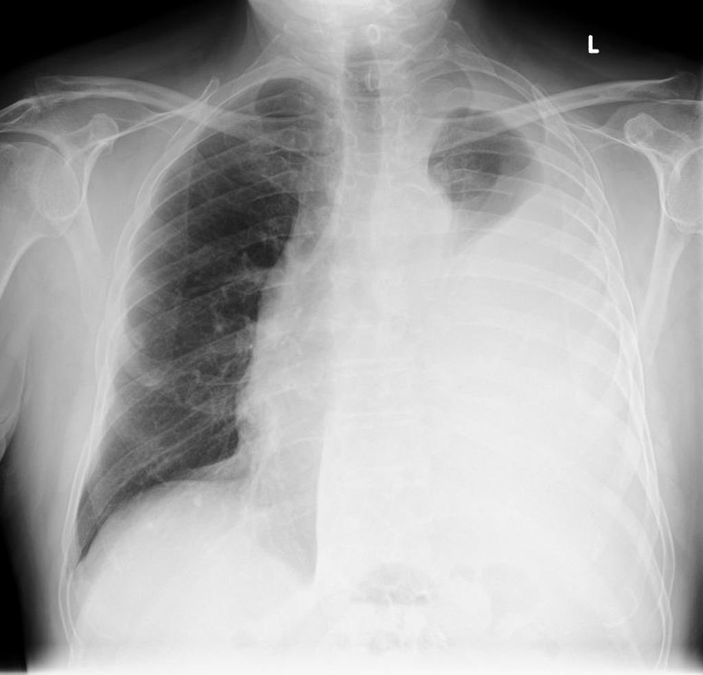 Mesothelioma Of The Pleural / A B Two Cases Of Malignant Pleural ...