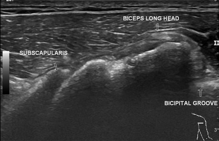 Subscapularis tendon tear | Radiology Case | Radiopaedia.org