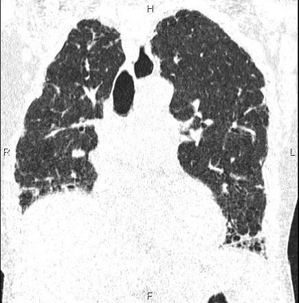 Pulmonary manifestation of scleroderma | Radiology Case | Radiopaedia.org