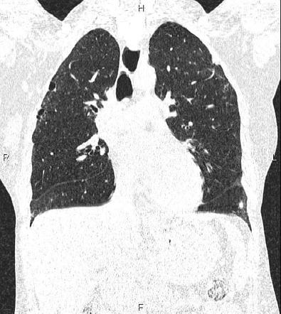 Pulmonary manifestation of scleroderma | Image | Radiopaedia.org