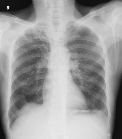 Juxtaphrenic peak sign | Radiology Reference Article | Radiopaedia.org