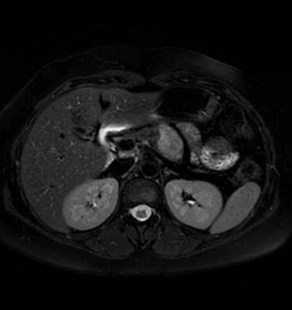 Pancreatic neuroendocrine tumour and serous cystadenoma | Radiology ...