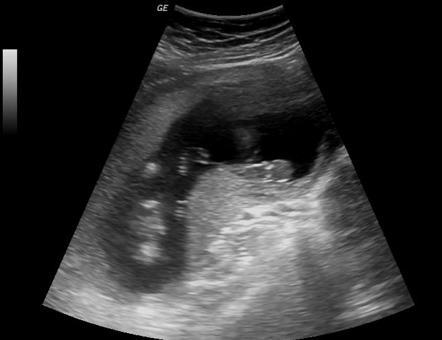 Absorbing Twin Ultrasound