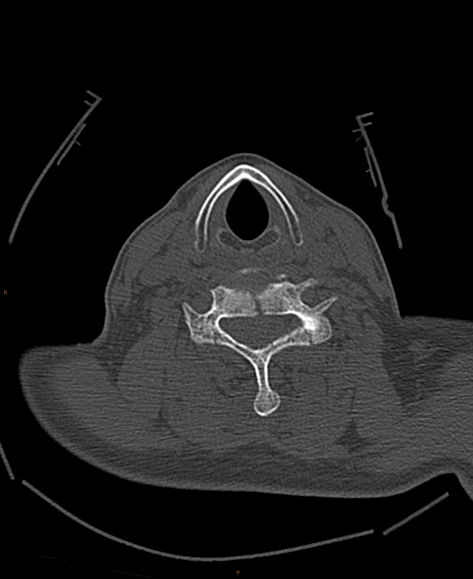 C6 compression fracture with posterior spinal fractures and cord ...