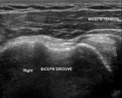 Ultrasound of the shoulder | Radiology Reference Article | Radiopaedia.org