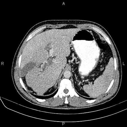 Portal vein thrombosis | Radiology Case | Radiopaedia.org