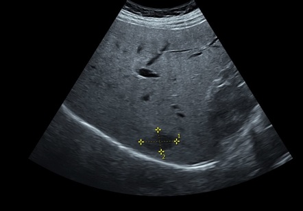 Hepatic hemangioma | Radiology Reference Article | Radiopaedia.org