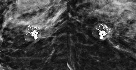 Popcorn calcification within the breast | Radiology Reference Article ...