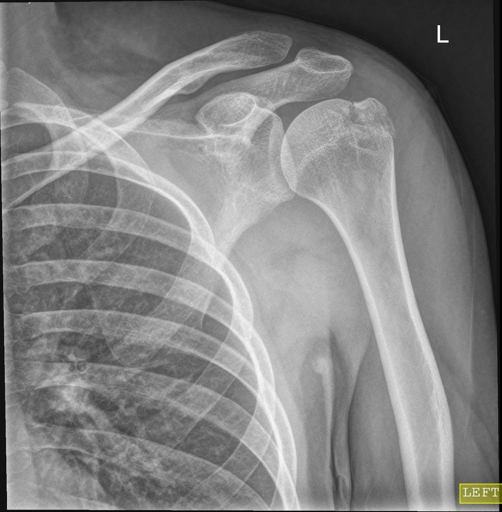 Greater Tubercle Of Humerus