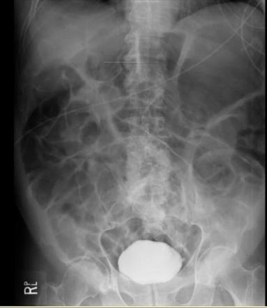 Paralytic Ileus