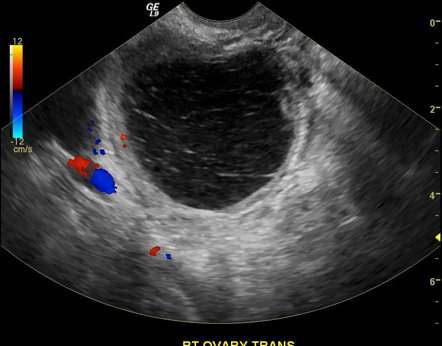 Simple Ovarian Cyst Treatment Sale Online | dakora.com.co