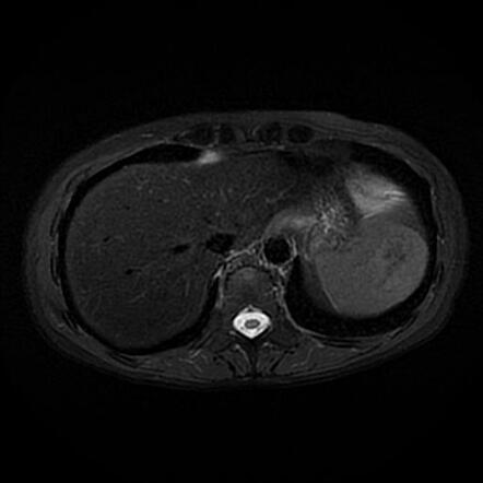 Splenic hemangioma | Radiology Case | Radiopaedia.org