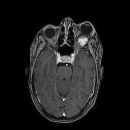 Spontaneous hematoma from orbital lymphangioma | Image | Radiopaedia.org