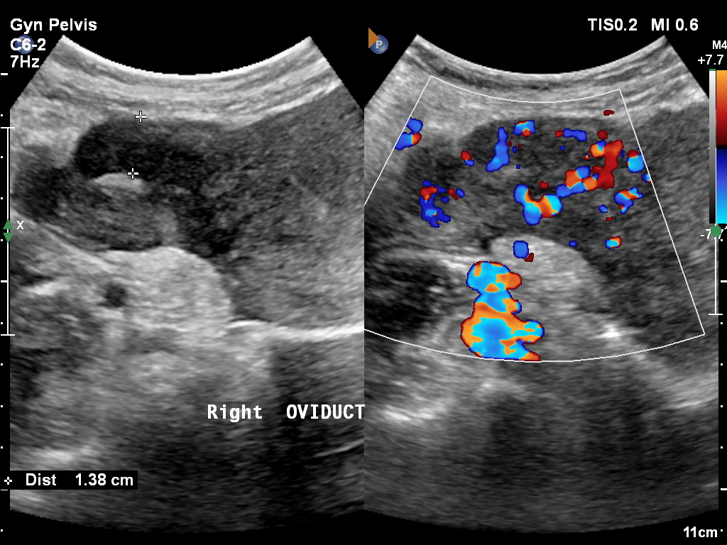 Salpingitis secondary to appendicitis | Image | Radiopaedia.org