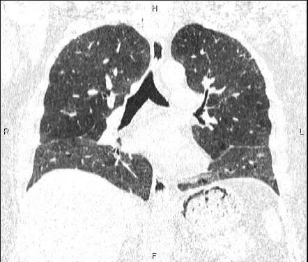 Early stage pulmonary fibrosis | Image | Radiopaedia.org