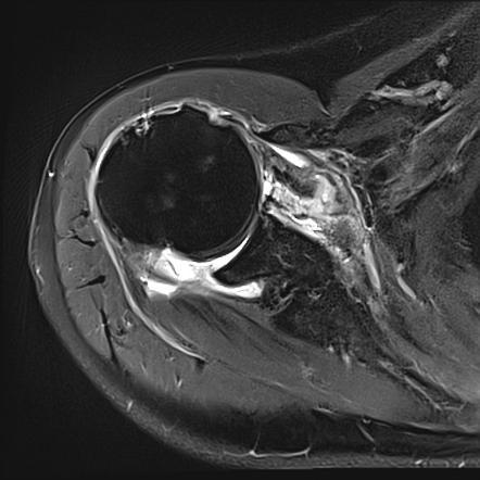 Subscapularis tendon tear | Radiology Reference Article | Radiopaedia.org