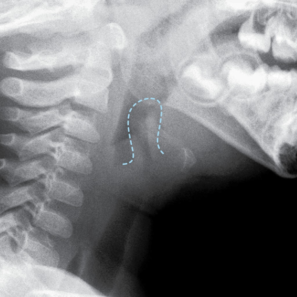 Normal Epiglottis X Ray