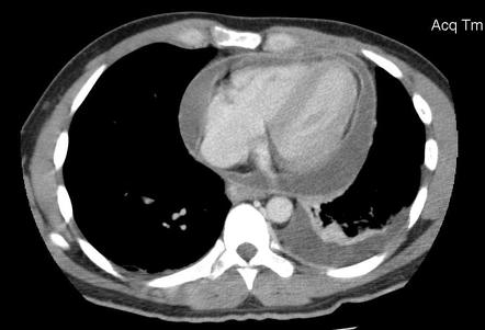 Cardiac Tamponade X Ray