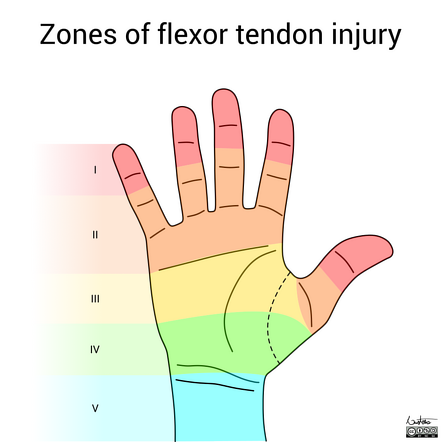 Zone classification of flexor tendon injury | Radiology Reference ...