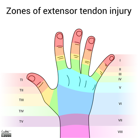 Zone classification of extensor tendon injury | Radiology Reference ...