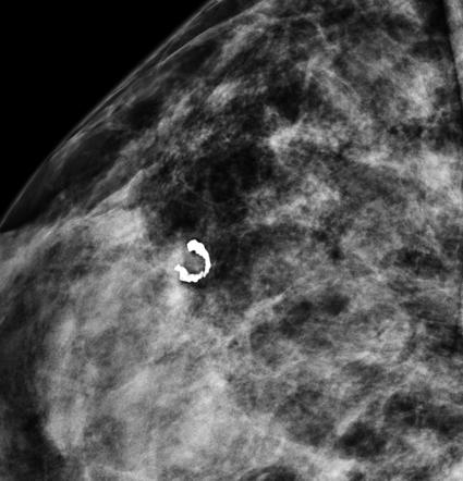 Popcorn calcification within the breast | Radiology Reference Article ...