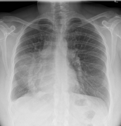 Scimitar syndrome | Radiology Case | Radiopaedia.org