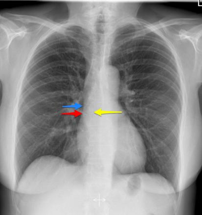 Viewing playlist: Chest - normals | Radiopaedia.org