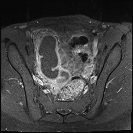 Imaging Of Pelvic Inflammatory Disease Part I Youtube - vrogue.co