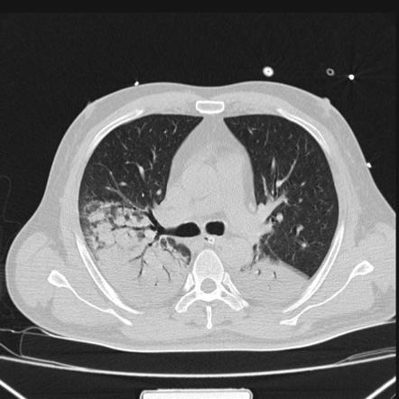 Consolidation | Radiology Reference Article | Radiopaedia.org