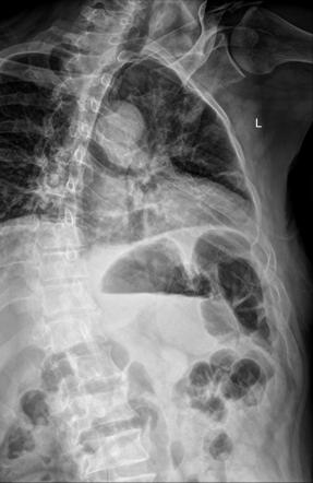 Ribs (AP oblique view) | Radiology Reference Article | Radiopaedia.org