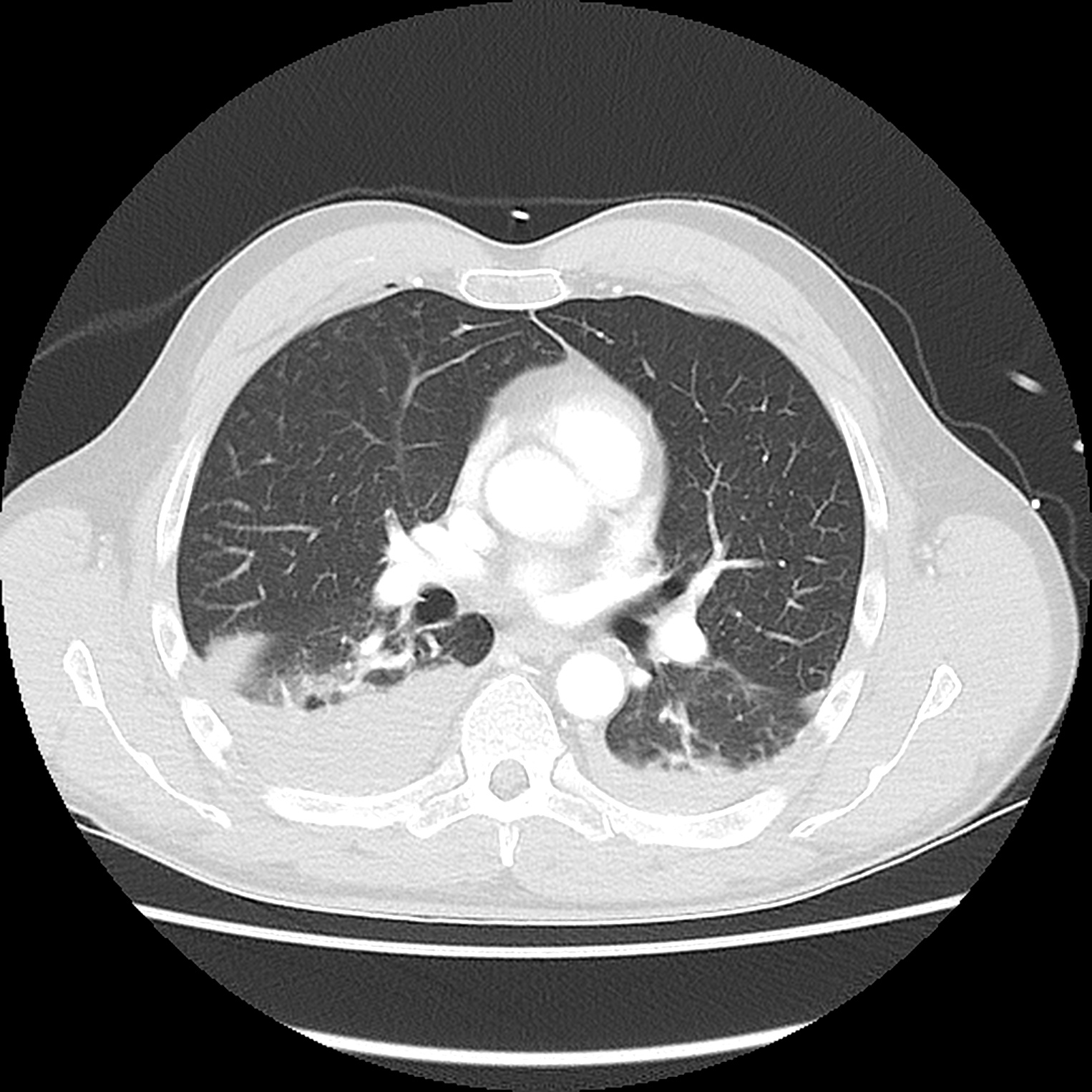 Hemothorax | Image | Radiopaedia.org