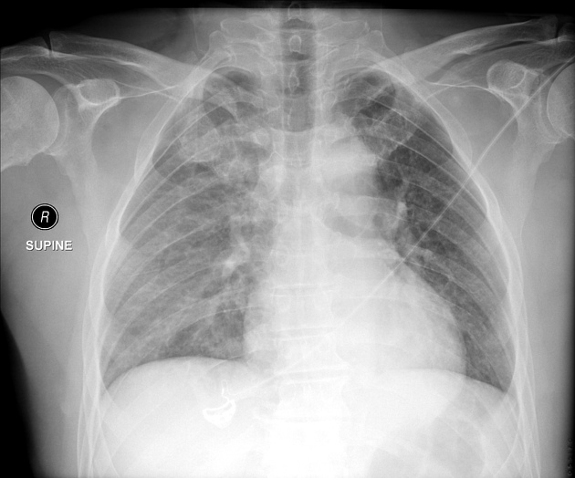 Left Hemothorax X Ray