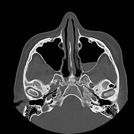 Maxillary fractures | Radiology Case | Radiopaedia.org