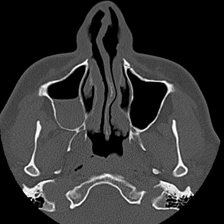 Zygomaticomaxillary Suture