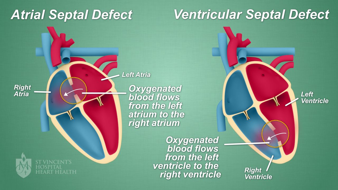 Atrial And Ventricular Septal Defects