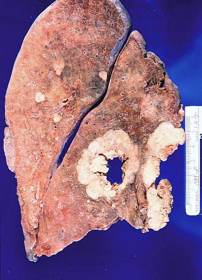 Metastatic Cancer - Gross