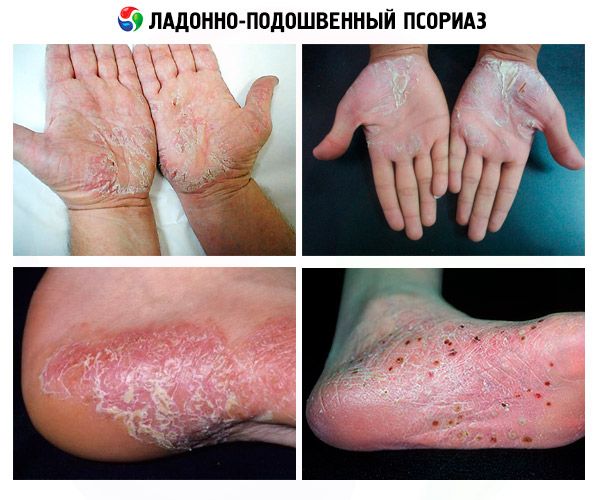 List 101+ Images Pictures Of Psoriasis On Elbows Sharp