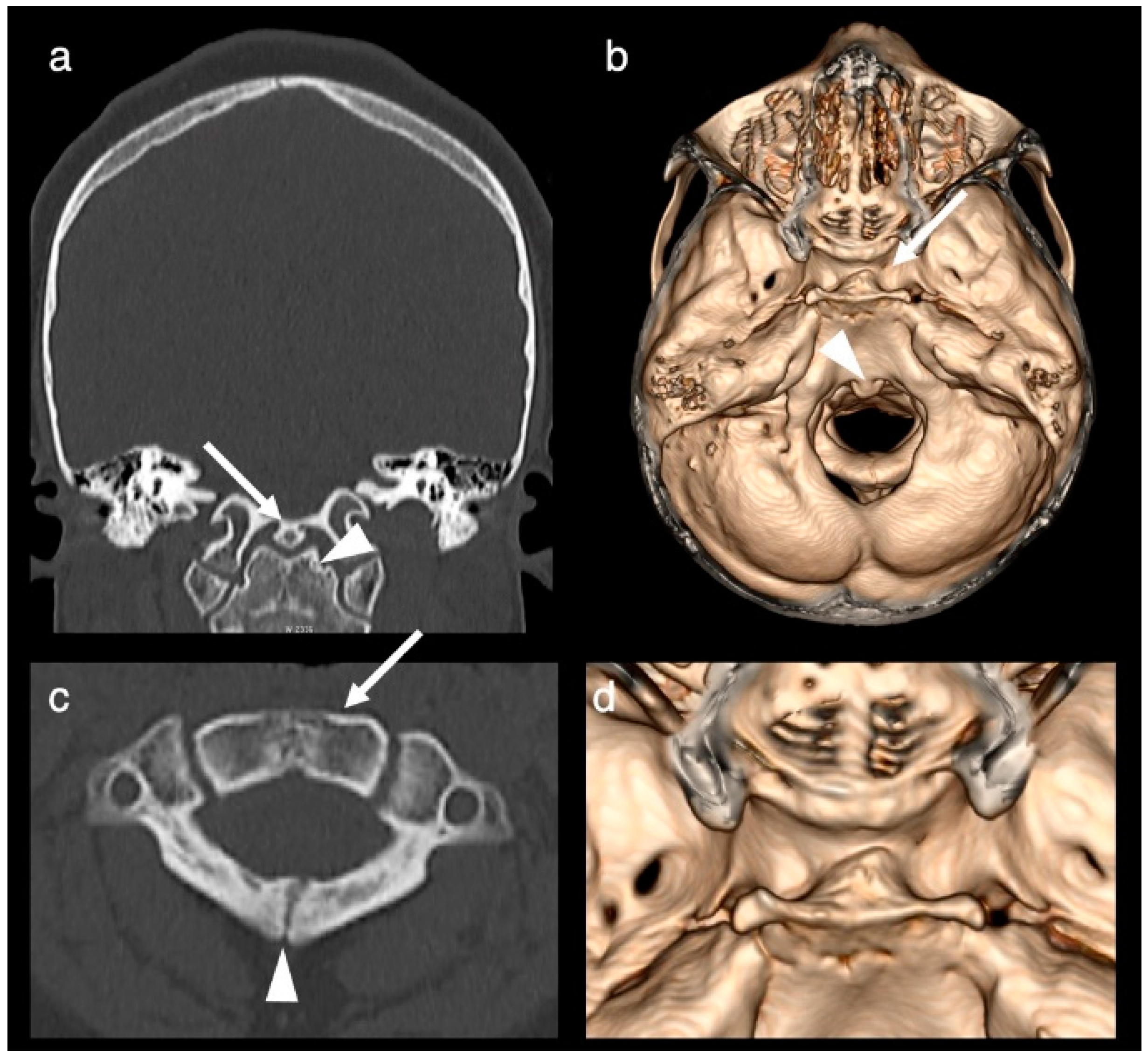 Duplication of the Pituitary Gland: CT, MRI and DTI Findings and ...