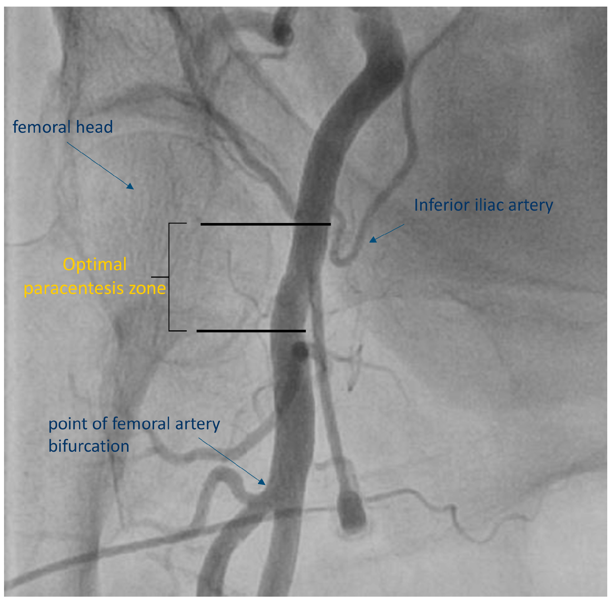 Femoral Pulse Landmark