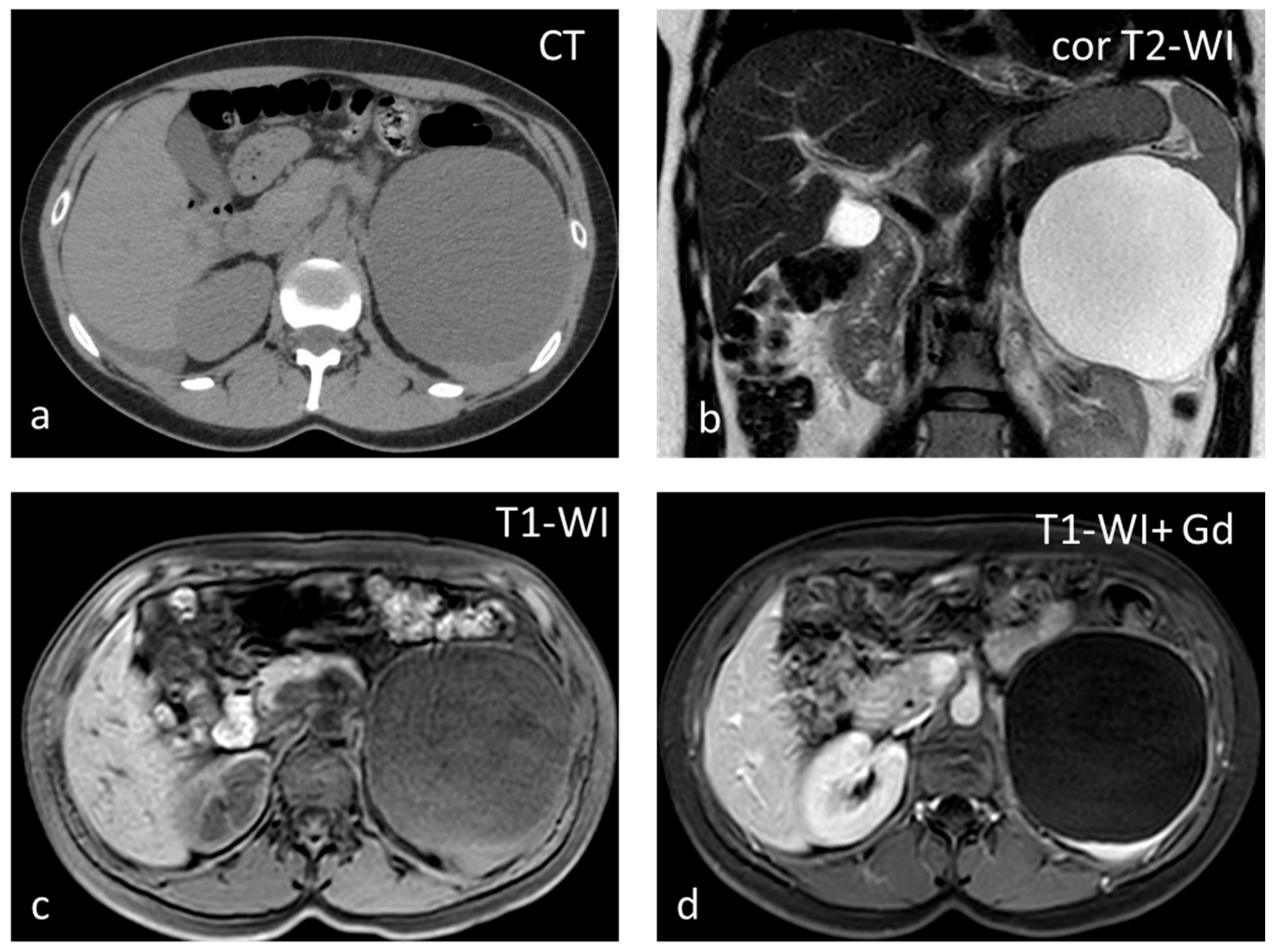 Diagnostics | Free Full-Text | The Spectrum of Solitary Benign Splenic ...