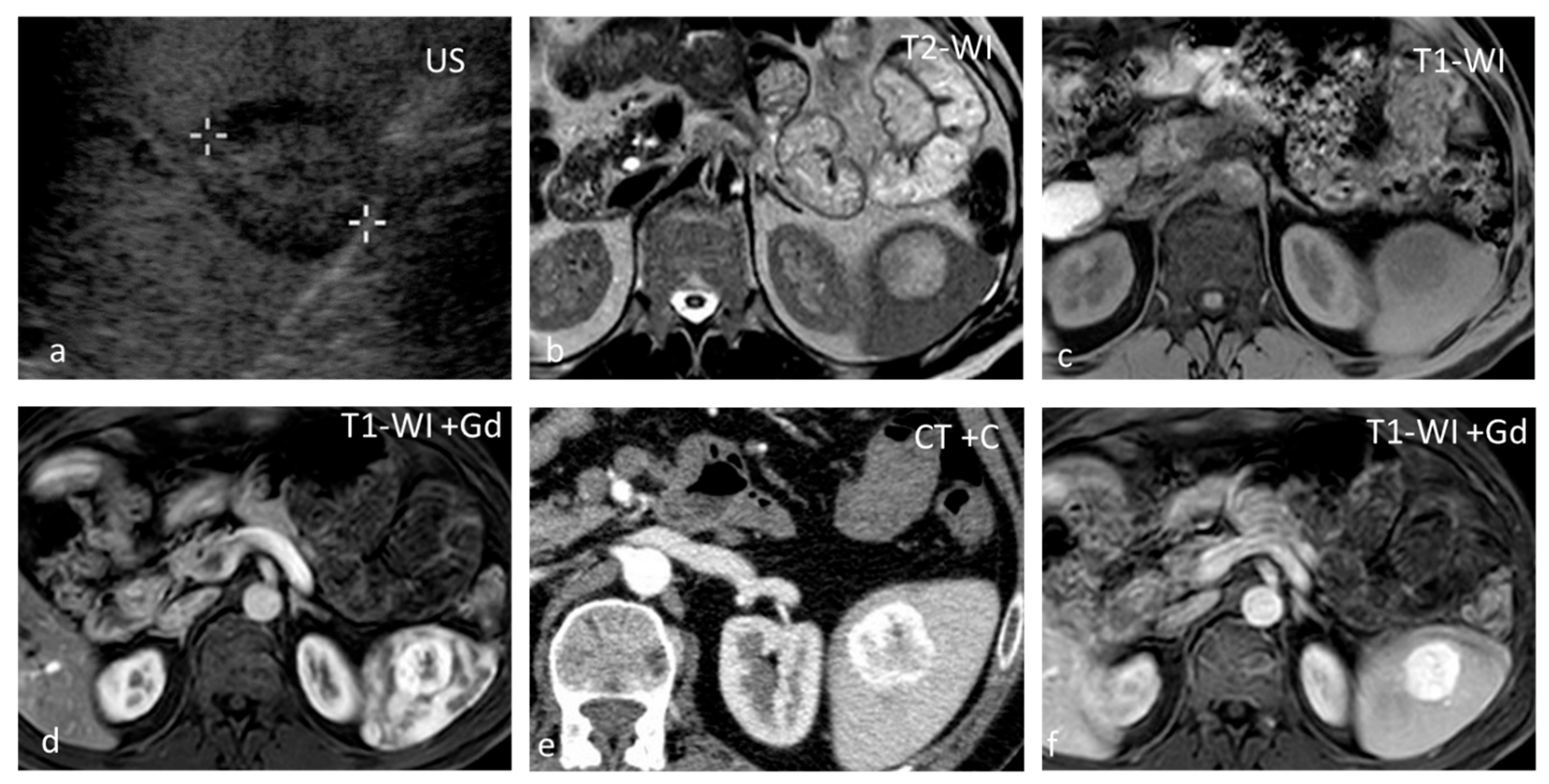 Diagnostics | Free Full-Text | The Spectrum of Solitary Benign Splenic ...